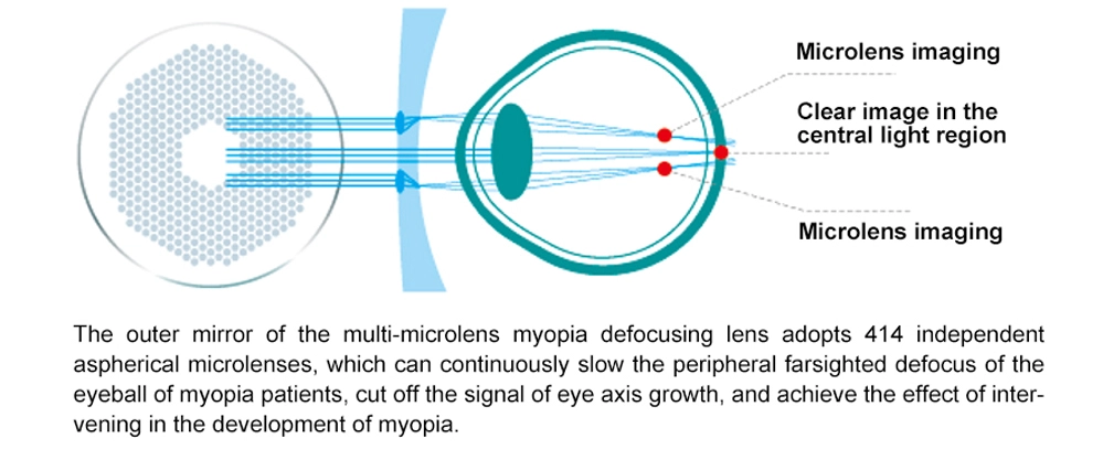 Advantages of 1.56/1.60 Defocus Multiple Mico Miyo Smart Kids Myopia Control Lenses