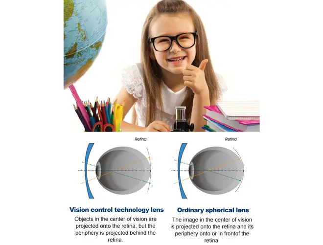 peripheral defocus lenses myovision-defocus-kids-myopia-control-single-vision-lens-1